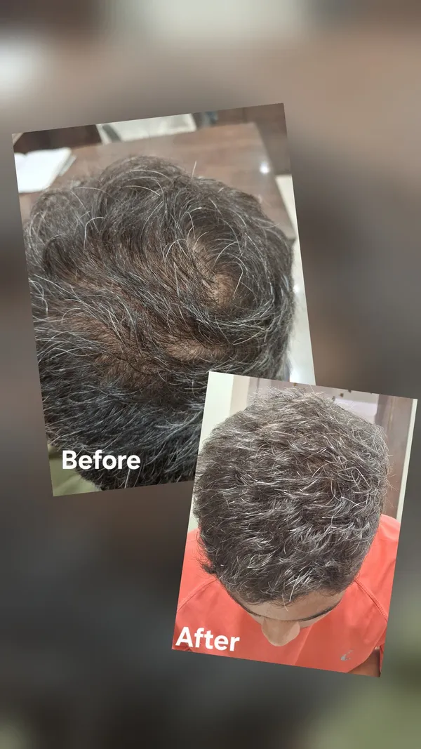 Hair density before and after treatment