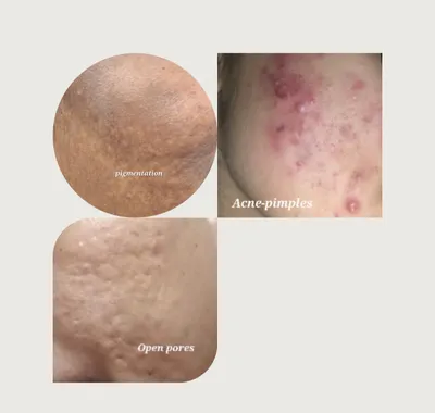Acne & Pimple Treatment at Sneha's Hair and Skin Clinic